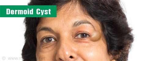 What Is Dermoid Cyst Dermoid Cyst Eyebrows Face