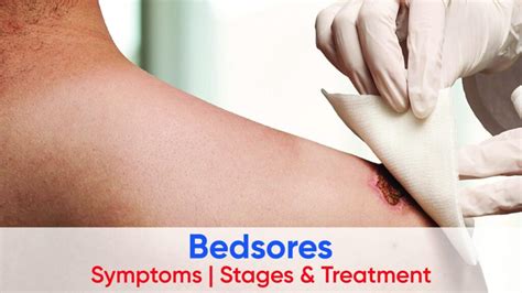 Bedsores Symptoms Stages And Treatment Laser Treatment In