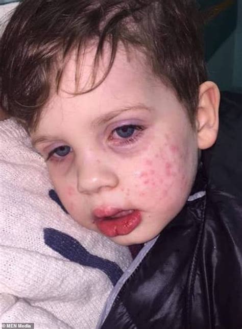 Mom Warned Parents Against Herpes After Her 3 Year Old Caught It When