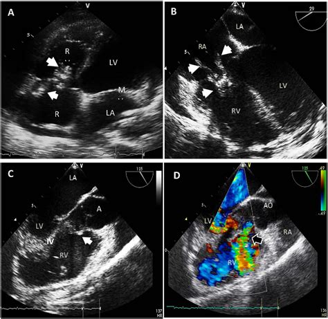 Figure 1 From Stenotrophomonas Maltophilia Right‐sided Endocarditis In