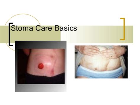 Stoma Care Dr Abhishek Mitra