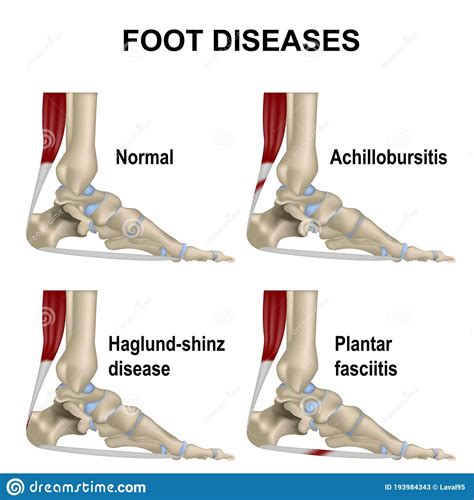 Foot Joint Normal Foot And Diseases Plantar Fasciitis
