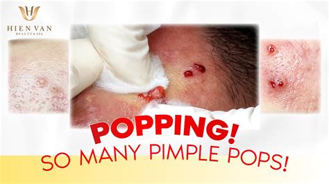 Popping So Many Pimple Pops Điều Trị Mụn Hiệu Quả Nhất Tphcm Tại Hiền Vân Spa I Anh Đức I Bài