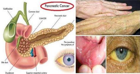 Pancreatic cancer symptoms and signs often do not manifest until the cancer has metastasized. Warning Signs of Pancreatic Cancer - Best Herbal Health
