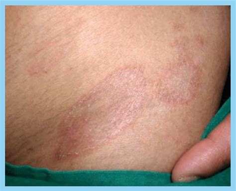 Patch Stage Mycosis Fungoides Showing Erythematous Scaly Patches In The