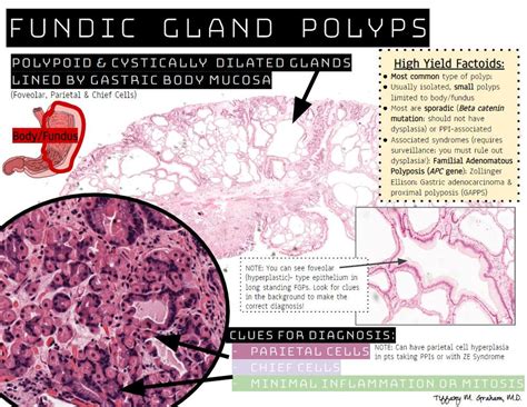 Fundic Gland Polyps In The Stomach