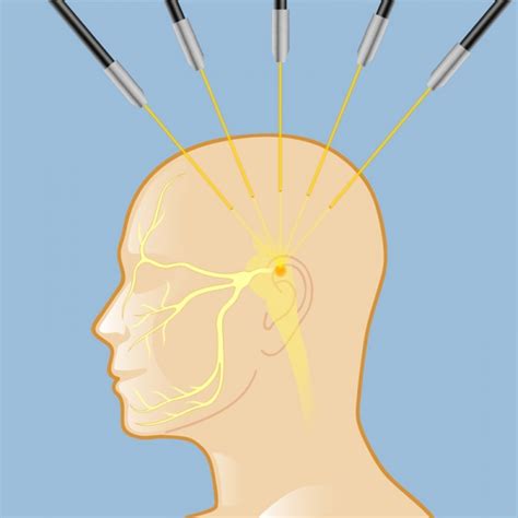 Trigeminal Neuralgia Radiosurgery Cascade Chiropractic And Wellness