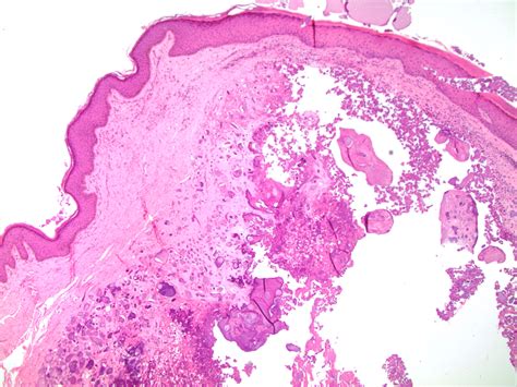 Pathology Outlines Idiopathic Scrotal Calcinosis