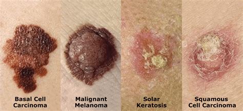 All About Cancer What Do Skin Cancers Look Like