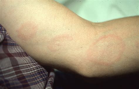 Circular Skin Rash On Arm