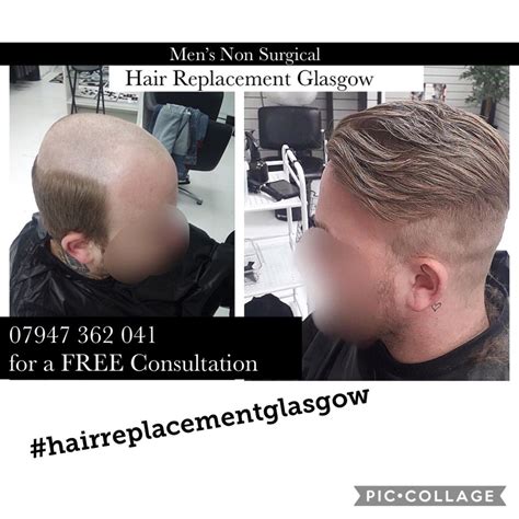 Hair Replacement Glasgow Hair Replacement Hair Loss Solutions Hair