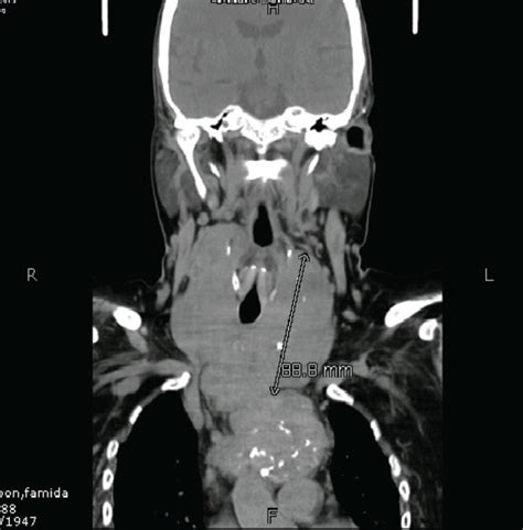 Ct Scan Demonstrating Retrosternal Extension Of Thyroid Mass In A