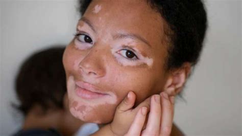 How To Detect Vitiligo Know Signs And Symptoms Of Skin Condition That