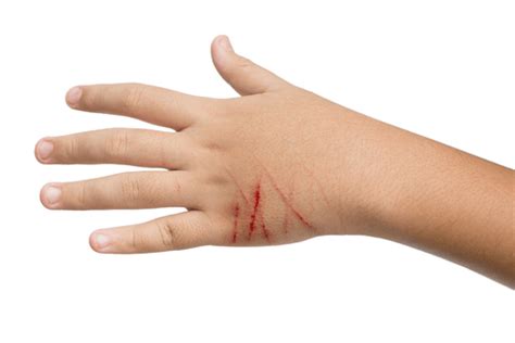 Cat Scratch Disease Skin Lesions