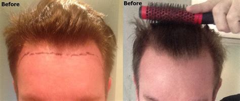 No Shave Fue Hairline Restoration Alvi Armani Hair Transplant Los