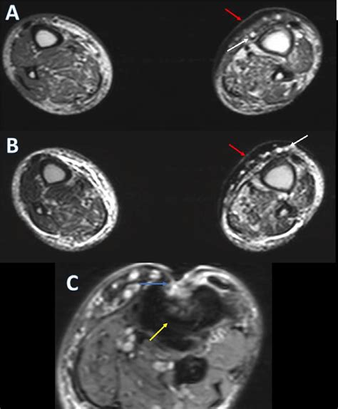 Mri Of Left Leg A And B Axial T1 And T2 Sequences Soft Tissue