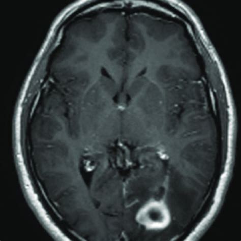 Preoperative Axial Gadolinium Enhanced T1 Weighted Image Showing A