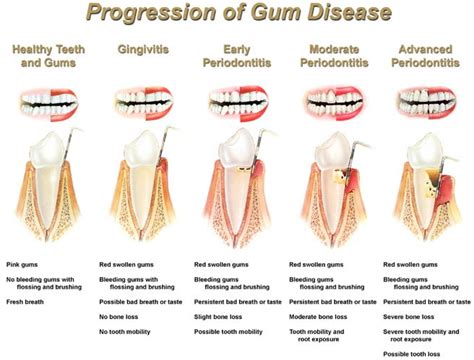 Progression Of Gum Disease Chart 1 Federal Way Dental Excellence