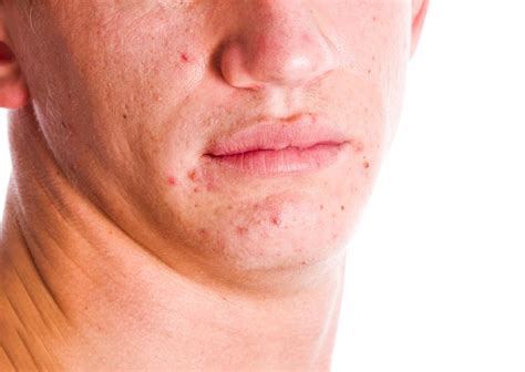 4 Different Types Of Acne Scars You Should Know About Simply Clinics
