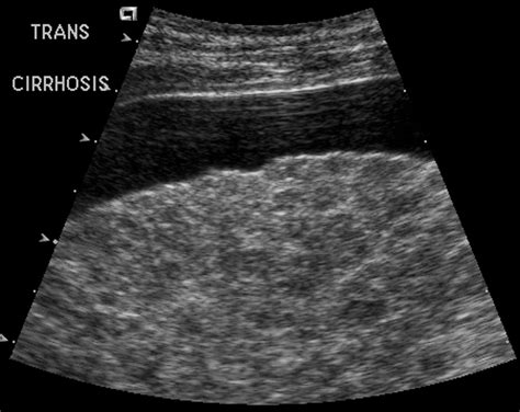 Cirrhosis Of The Liver Ultrasound Fxnyjrnv Abd 200 Mod 3 Ultrasound