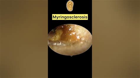 Myringosclerosis And Tympanosclerosis In Hindi Youtube