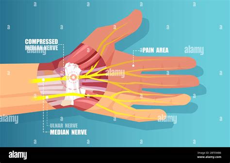 Medical Illustration Vector Of A Carpal Tunnel Syndrome With Median