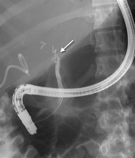 Bile Duct Obstruction After Cholecystectomy Caused By Clips Undo What