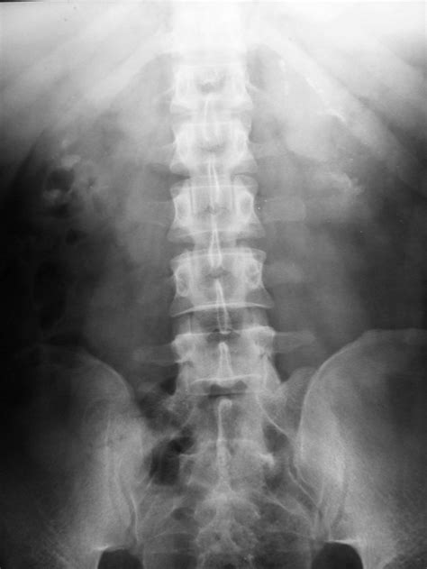 Abdominal Radiograph Multiple Pyelic And Caliciel Bilateral