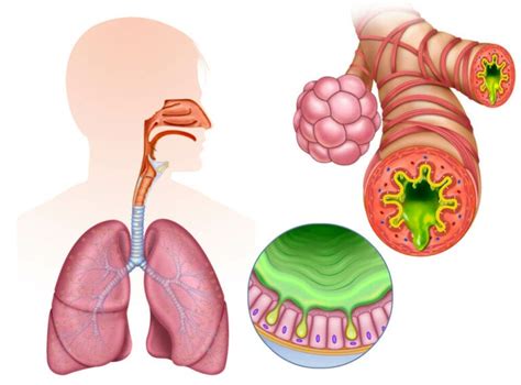 Remedios Efectivos Para La Bronquitis Aguda Mejor Con Salud The Best Porn Website