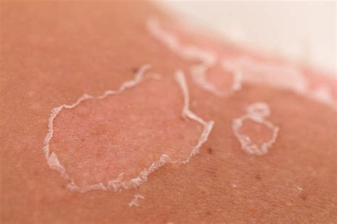 Scientific Sunburn And Skin Cancer Part 2