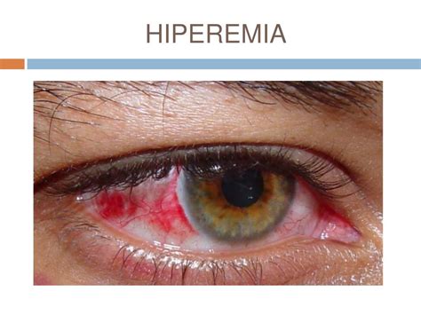 O Que é Hiperemiada
