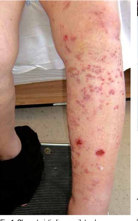 Hsv infection may begin with itching, which is a sub. Figure 1 from Herpes zoster following intra-articular ...