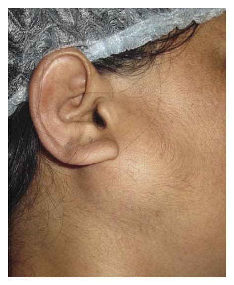 Preoperative Clinical Picture Showing The Well Defined Swelling