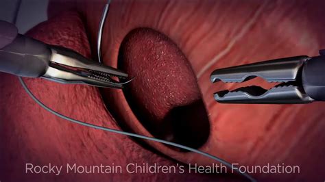 Minimally Invasive Surgery For Congenital Diaphragmatic Hernia Youtube