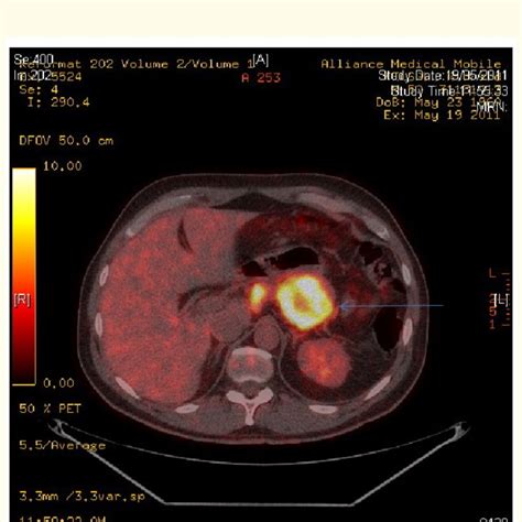 Pet Ct Scan Showing Pancreatic Cancer Recurrence Download Scientific