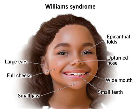 These Are The Symptoms Of Williams Syndrome Medizzy