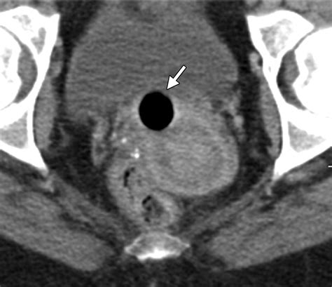 normal or abnormal demystifying uterine and cervical contrast enhancement at multidetector ct