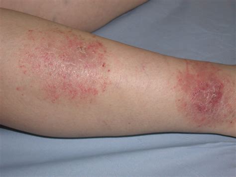 Eczema Legs Dorothee Padraig South West Skin Health Care