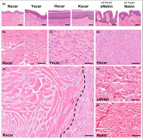 Keloid Histology