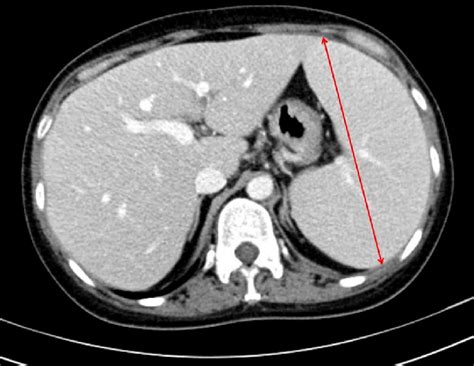 Mild Hepatomegaly And Splenomegaly Are Seen By Ct Maximal Diameter Of