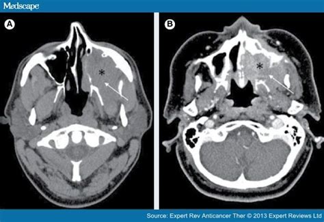 Imaging And Resectability Issues Of Sinonasal Tumors
