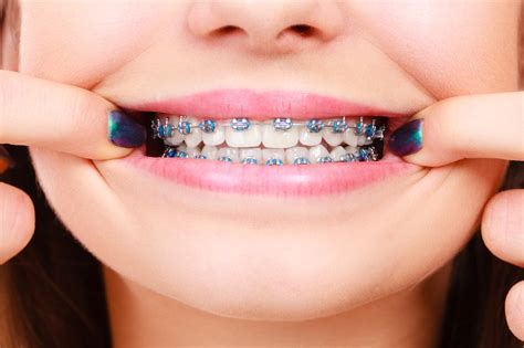 brackets de colores cómo elegir el mejor color para tus dientes