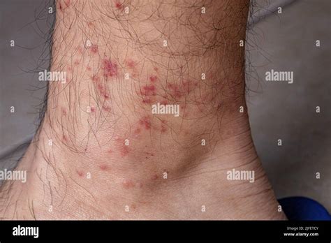 Human Skin With Various Allergic Reactions To Tick Bites With Selective