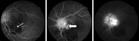 Fundus Fluorescein Angiography Images Of The Left Eye Showing Blocked