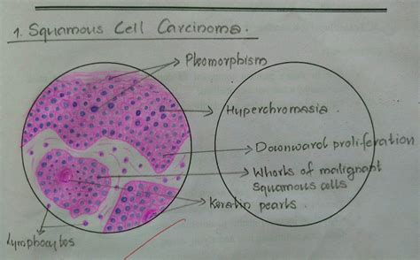 Histopathology Drawings Squamous Cell Carcinoma