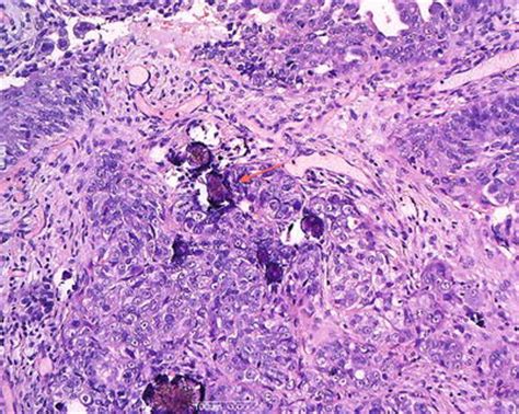 Mesothelioma is an important cause of lobulated or nodular pleural thickening (fig. Histopathology | Radiology Key
