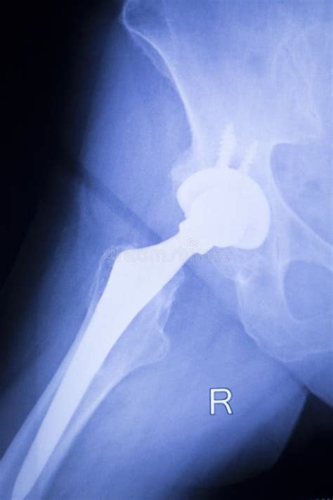 Hip Replacement Xray Orthopedic Medical Scan Stock Photo Image Of