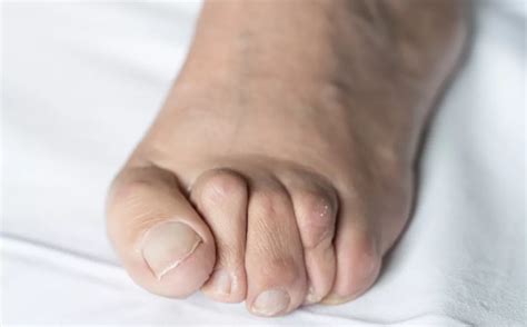 Hammer Toe Correction Surgery Orthopaedic Specialists Of Austin