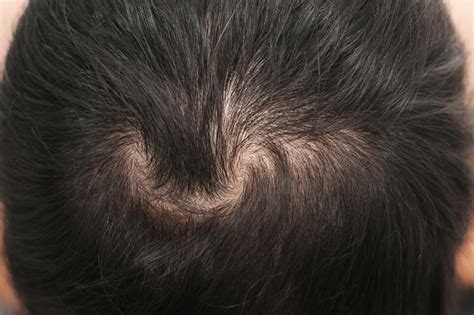 Causes Of Excessive Hair Loss Hair Loss Topic