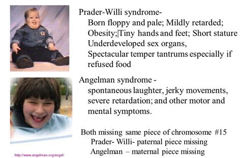 Prader Willi Syndrome And Angelman Syndrome Have The Same My XXX Hot Girl